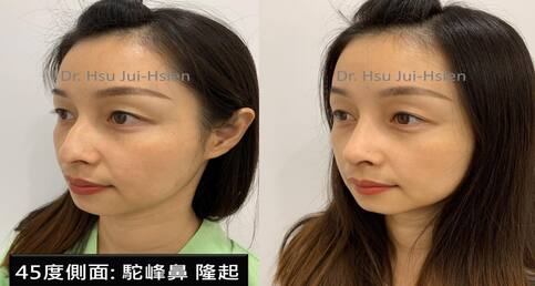 一次解決歪鼻、鷹鈎駝峰鼻、嚴重鼻塞三大問題！