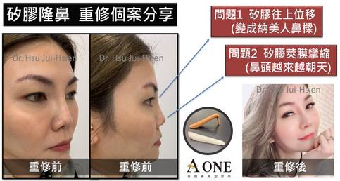 【韓式三段式隆鼻重修手術】重修(矽膠隆鼻)案例分享