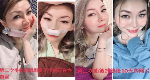 【韓式三段式隆鼻重修手術】重修(矽膠隆鼻)案例分享