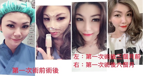 【韓式三段式隆鼻重修手術】重修(矽膠隆鼻)案例分享