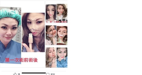 【韓式三段式隆鼻重修手術】重修(矽膠隆鼻)案例分享