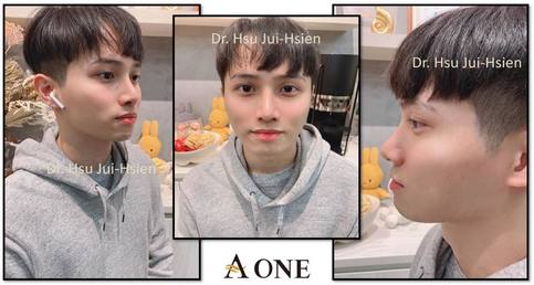 韓國歐巴鼻型分析&男性隆鼻案例分享