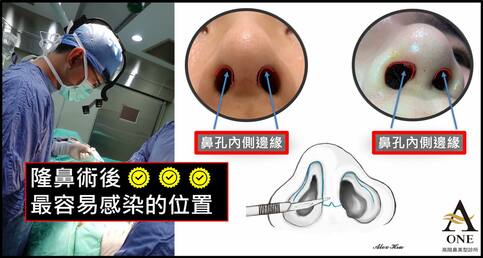 隆鼻手術最容易發生感染的位置？
