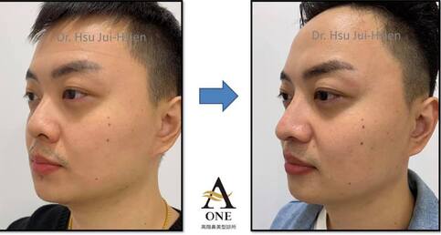 手術術式： 標準三段式隆鼻手術