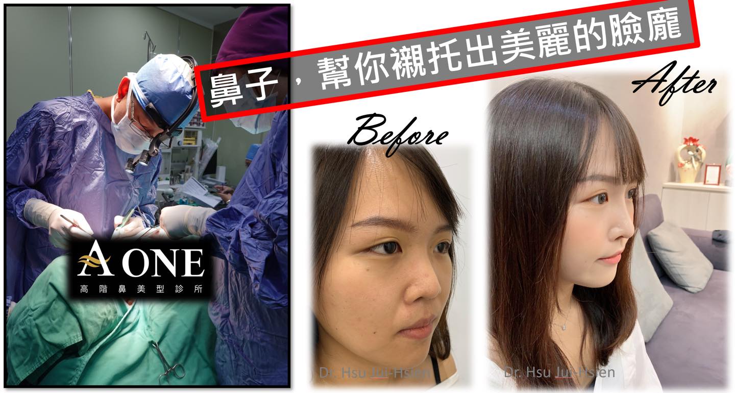 手術術式： 標準三段式隆鼻手術