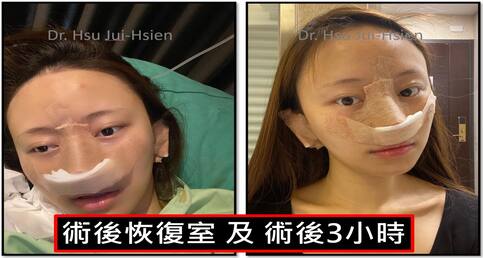 標準三段式隆鼻手術個案詳細紀錄✍️