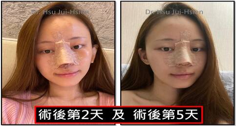 標準三段式隆鼻手術個案詳細紀錄✍️