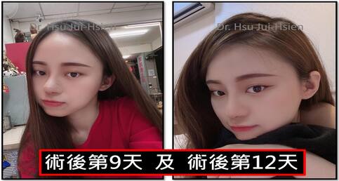 標準三段式隆鼻手術個案詳細紀錄✍️