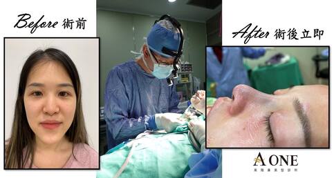 藉隆鼻手術改善視覺上下巴厚道問題！