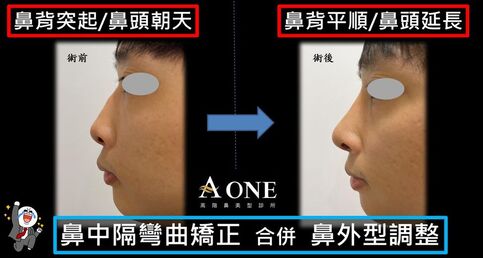 鼻中膈彎曲矯正+鼻外型調整